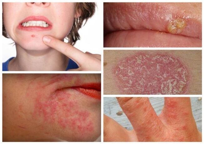 Alergije i kožne bolesti znakovi su parazita u tijelu