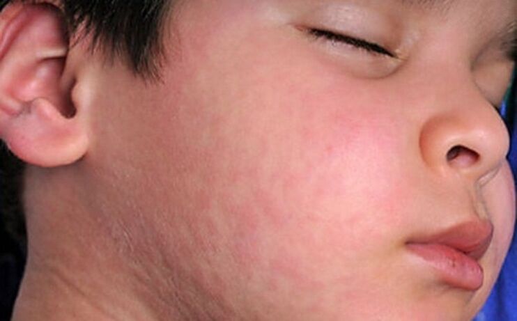 Alergijski osip na koži - simptom prisutnosti parazitskih crva u tijelu